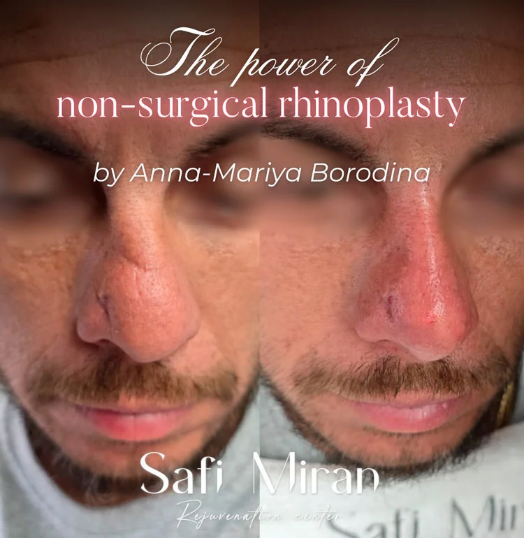 Male non-surgical rhinoplasty before and after result