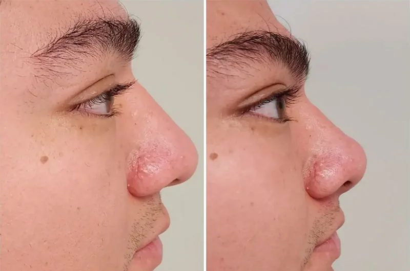 Non-surgical rhinoplasty for men before and after