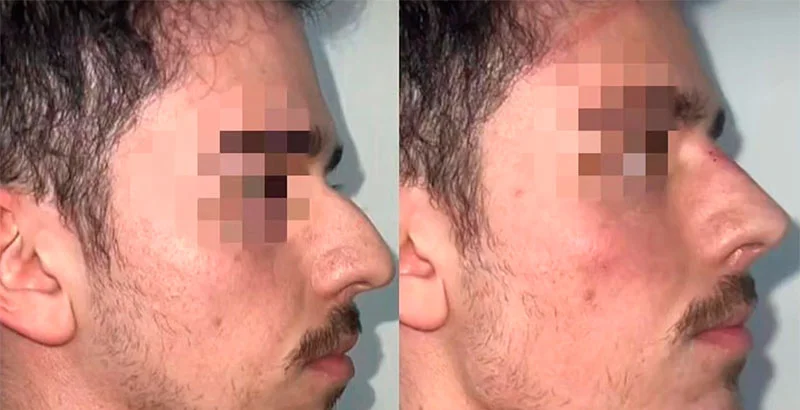 Non-surgical nose job for men before and after