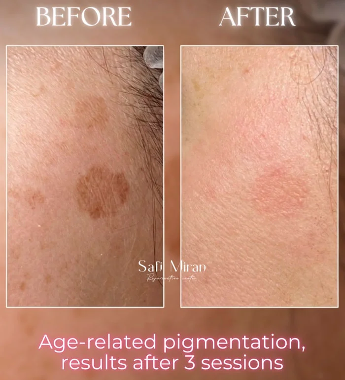 Age-related pigmentation treatment before and after three IPL sessions