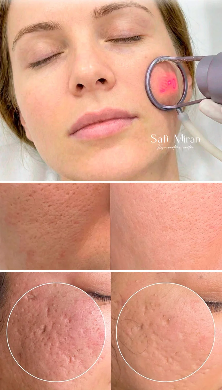 Deep laser resurfacing in Denver, CO