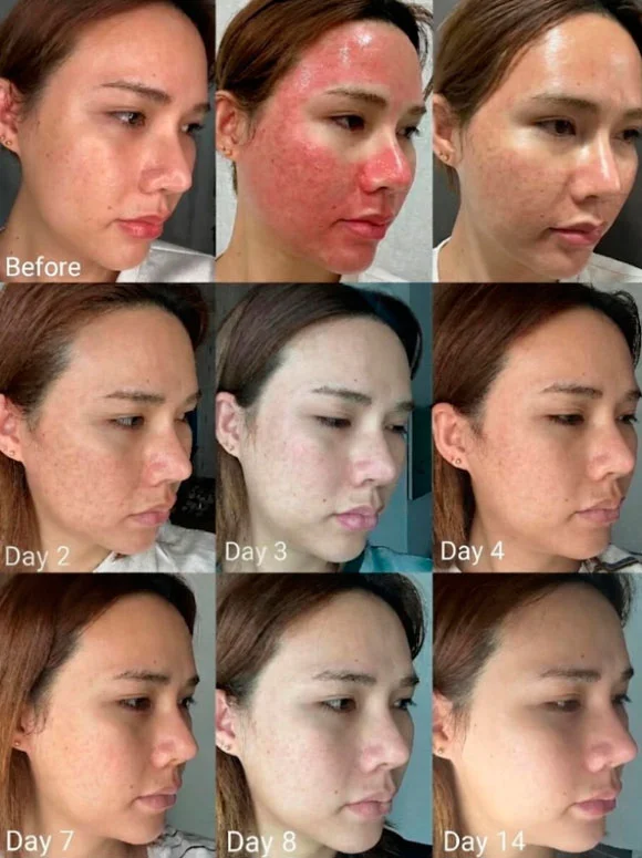 Deep laser resurfacing recovery timeline
