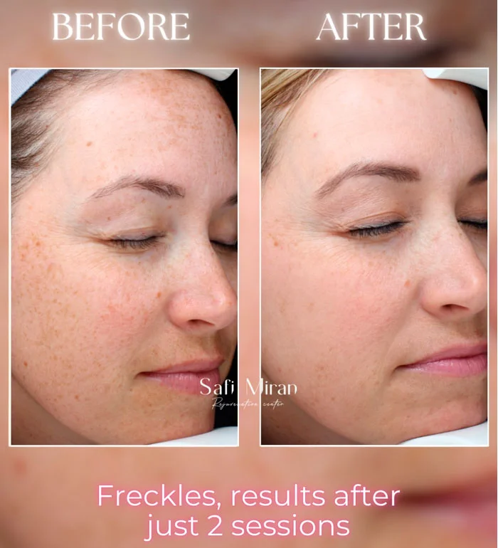 Freckle treatment before and after two IPL sessions