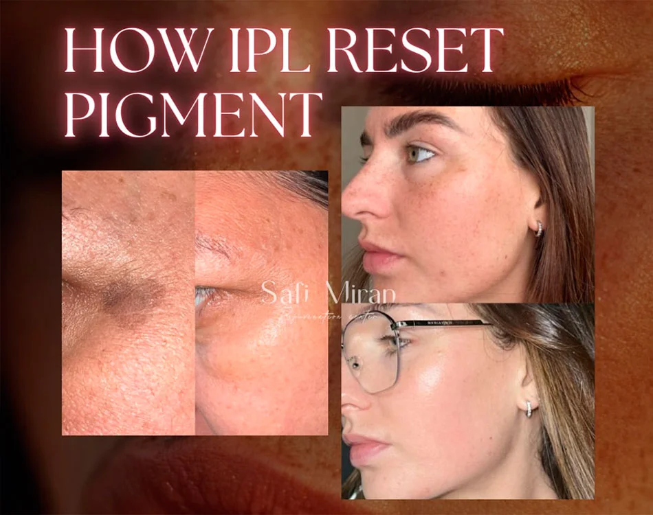 How IPL reset pigment