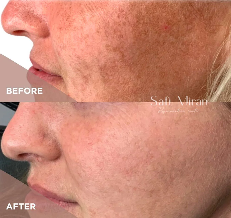 IPL for hyperpigmentation before and after
