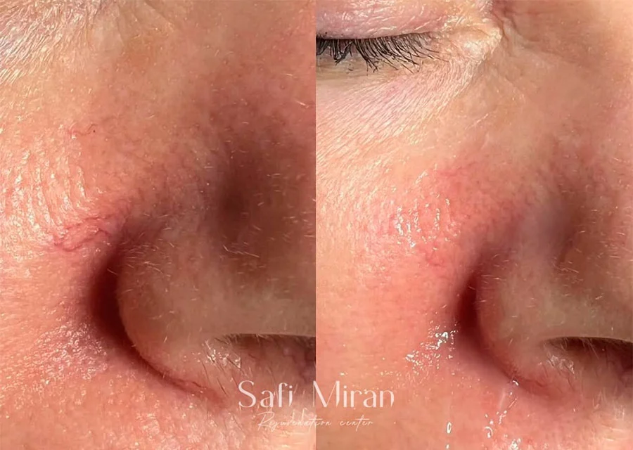 IPL for redness and telangiectasias before and after