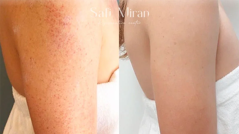 IPL photofacial before and after result