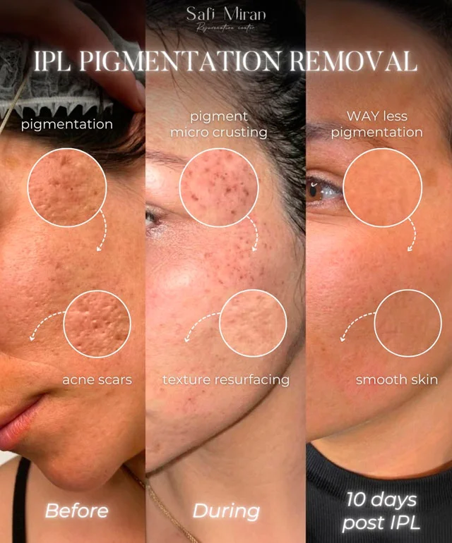 IPL skin treatment before and after