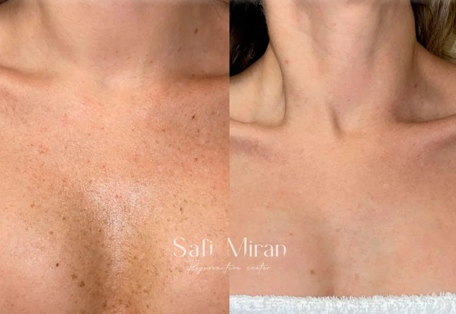 IPL treatment before and after result