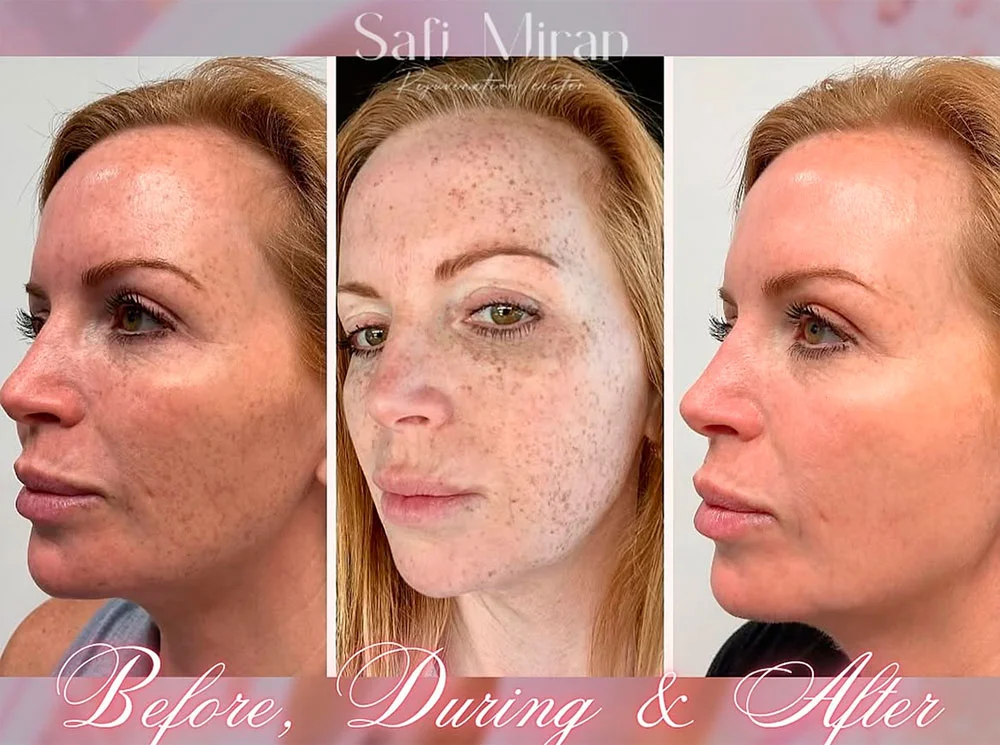 IPL treatment before and after