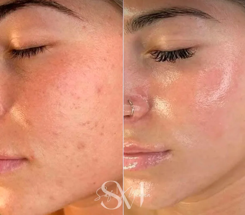 RF microneedling before and after photo
