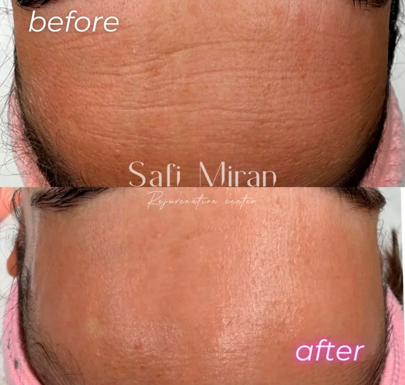 RF microneedling before and after