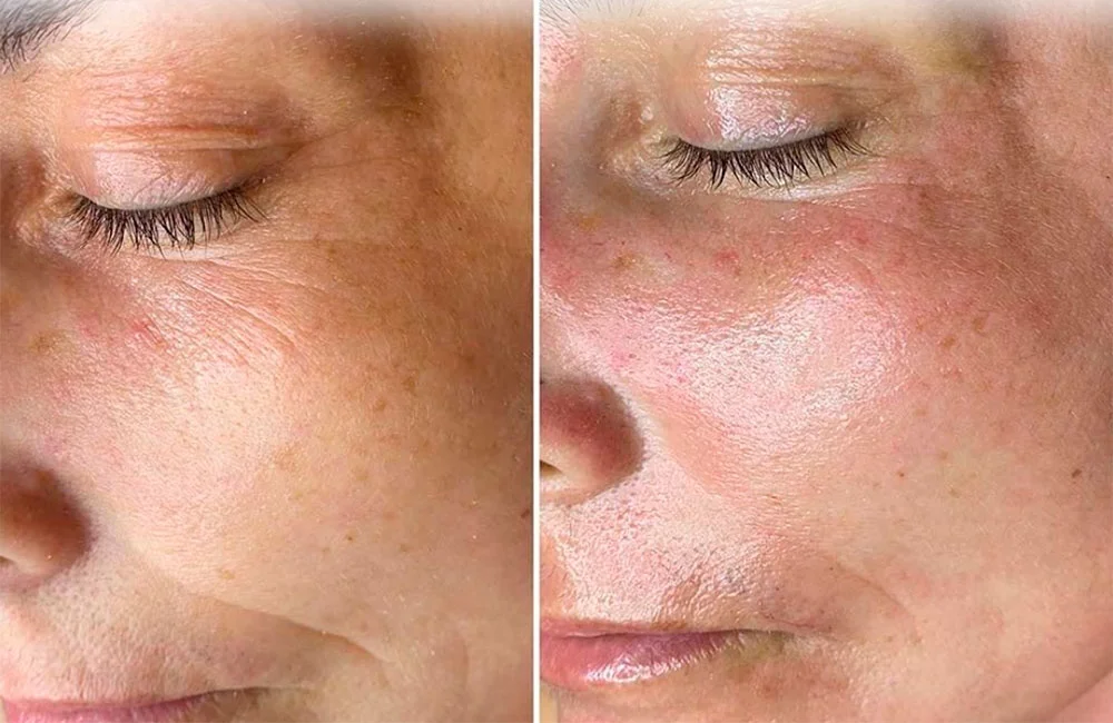 RF microneedling before and after photos