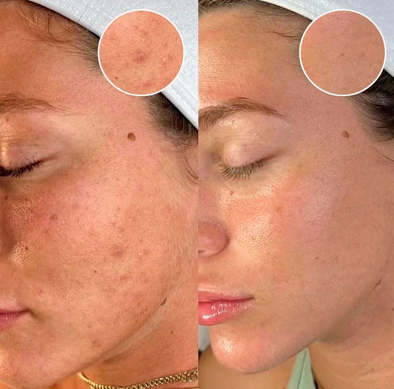 RF microneedling before and after