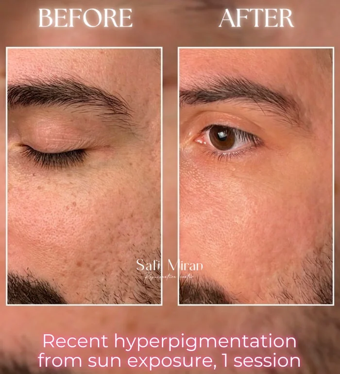 Sun-induced hyperpigmentation before and after one IPL session