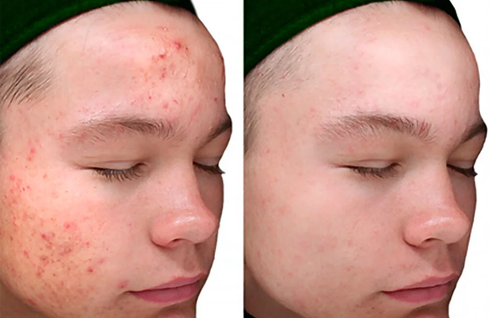 VI Peel before and after