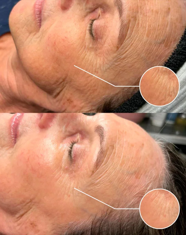 VI Peel before and after treatment result