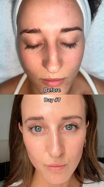 VI Peel before and after photo
