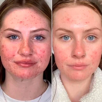 VI Peel before and after result