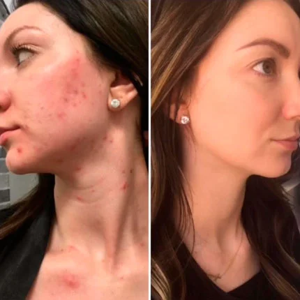 VI Peel before and after result
