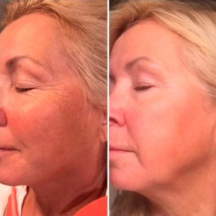 VI Peel before and after