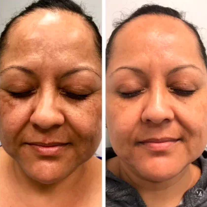 VI Peel before and after