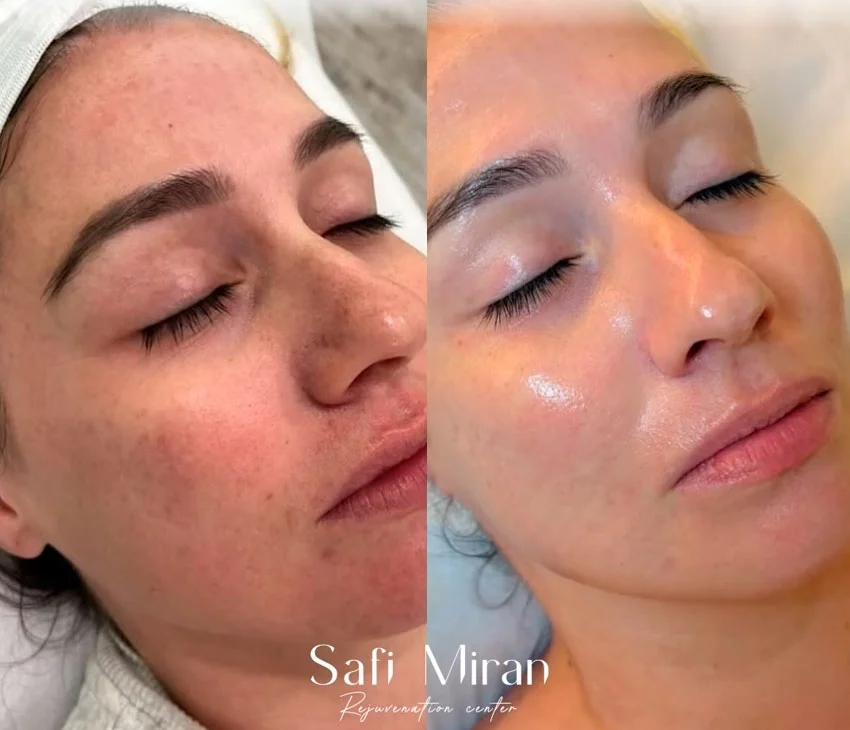 VI Peel before and after photos