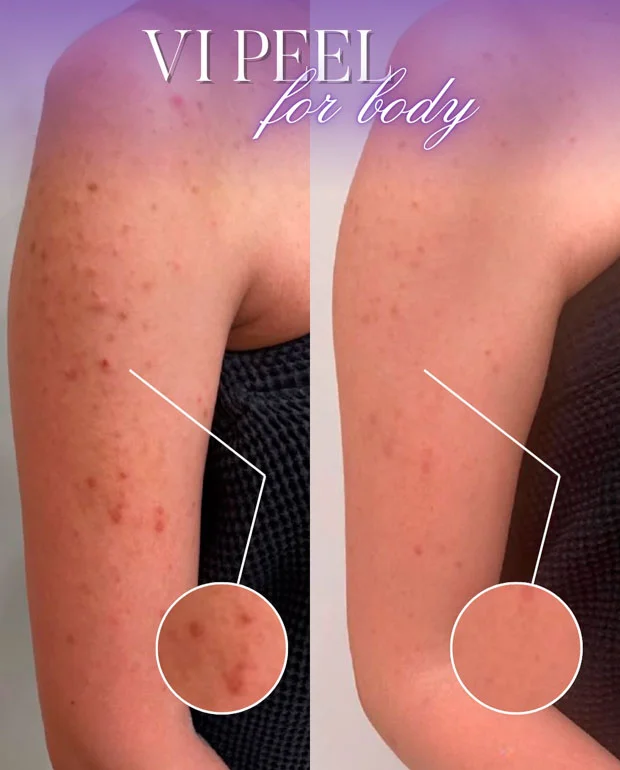 VI Peel for body before and after result