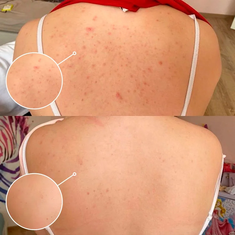 VI Peel for body before and after