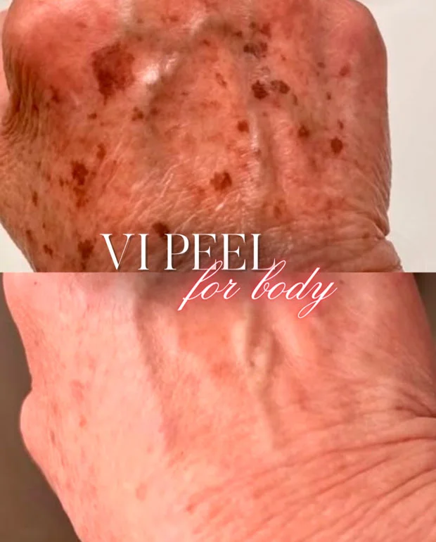 VI Peel for body before and after photo