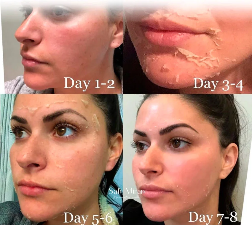 VI Peel recovery time and skin peeling stages